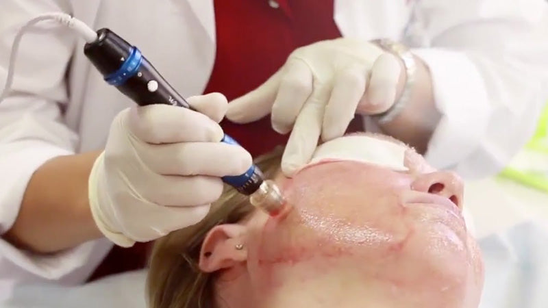 Natural Skin Glow with Collagen Induction Treatment