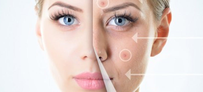 micro-needling-treatment-in-hollywood