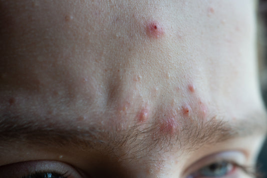 Depressed Acne Scar: Causes And Treatment Options