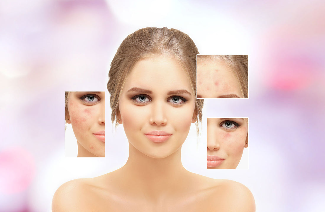 Acne,Skin concern,blemish-prone skin and acne