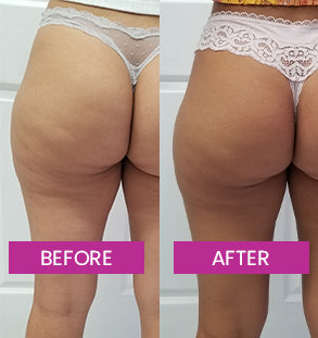 CELLULITE_BEFORE_AND_AFTER
